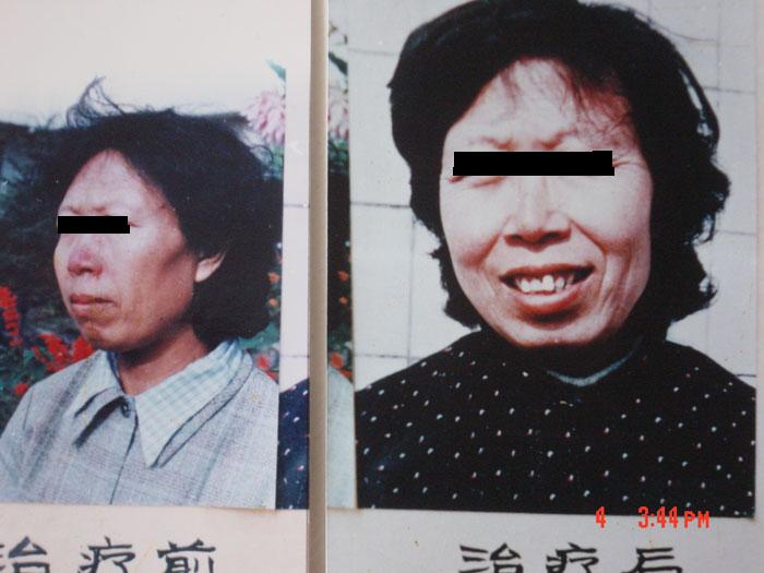 中州药膏使用(yòng)前后对比1