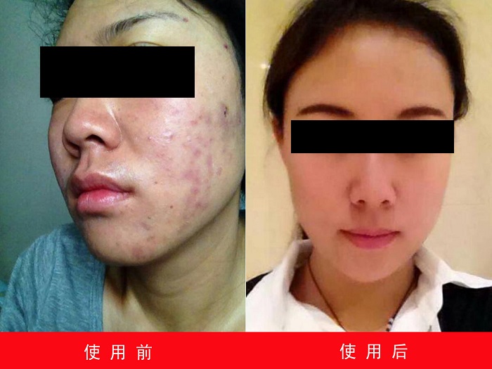 中州药膏使用(yòng)前后对比