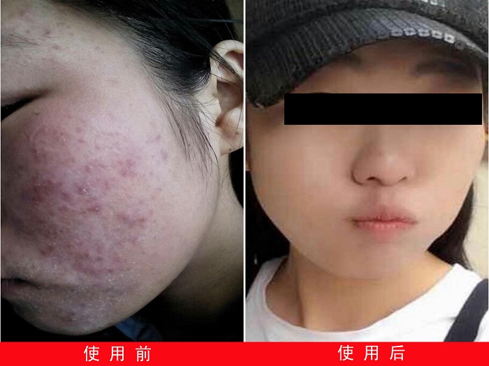 中州药膏使用(yòng)前后对比