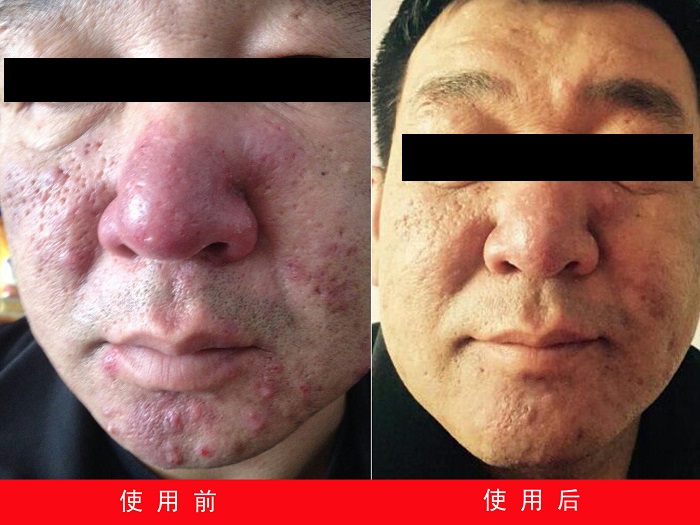 中州药膏使用(yòng)前后对比